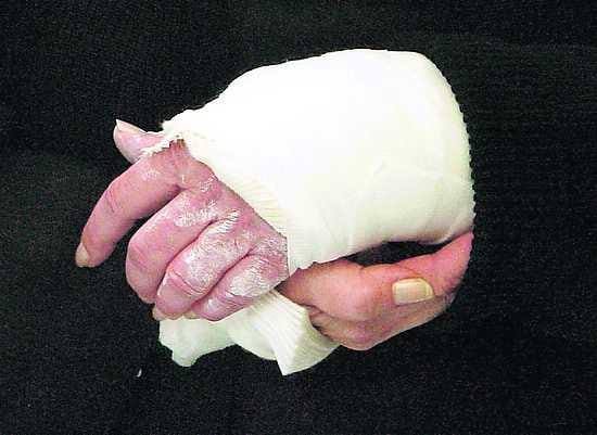 Hauraat luut. Osteoporoosia sairastava saa helposti luun murtumia. Tutkimusten mukaan lääkitys vähentää luunmurtumien riskin alle puoleen. Hyöty häviää, jos lääkitys lopetetaan.