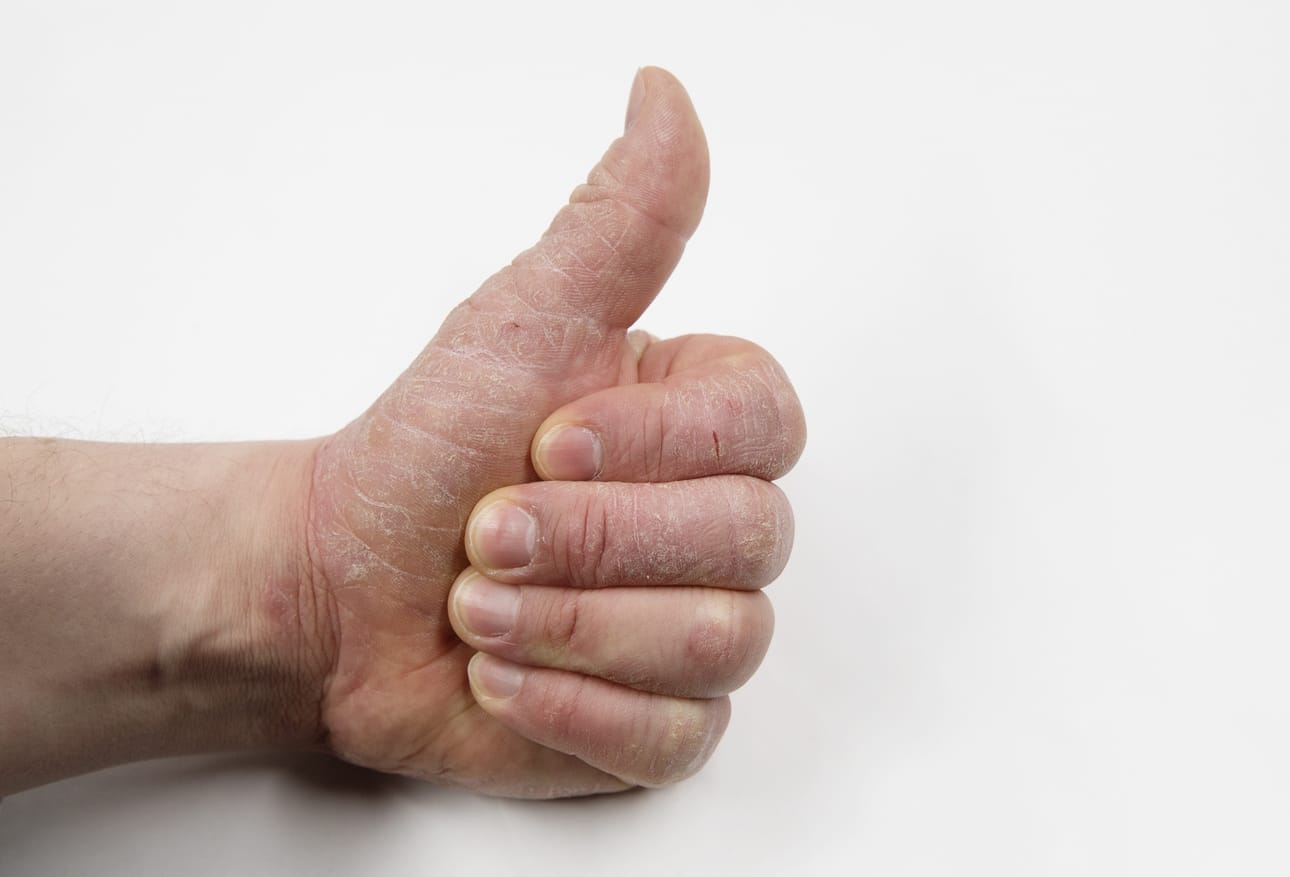 Peukalosta kannattaa pitää huolta pilkkireissuilla. Kuvituskuva.