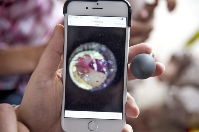 Mobiilikorva-tutkimus osoitti, että lääkärit pystyivät toteamaan tai poissulkemaan oireisella lapsella äkillisen välikorvatulehduksen 87 prosentissa vanhempien kuvaamista tärykalvovideoista. Kuvaamisen mahdollisti älypuhelimeen kiinnitettävällä korvalamppu. KUVA: Jori Liimatainen