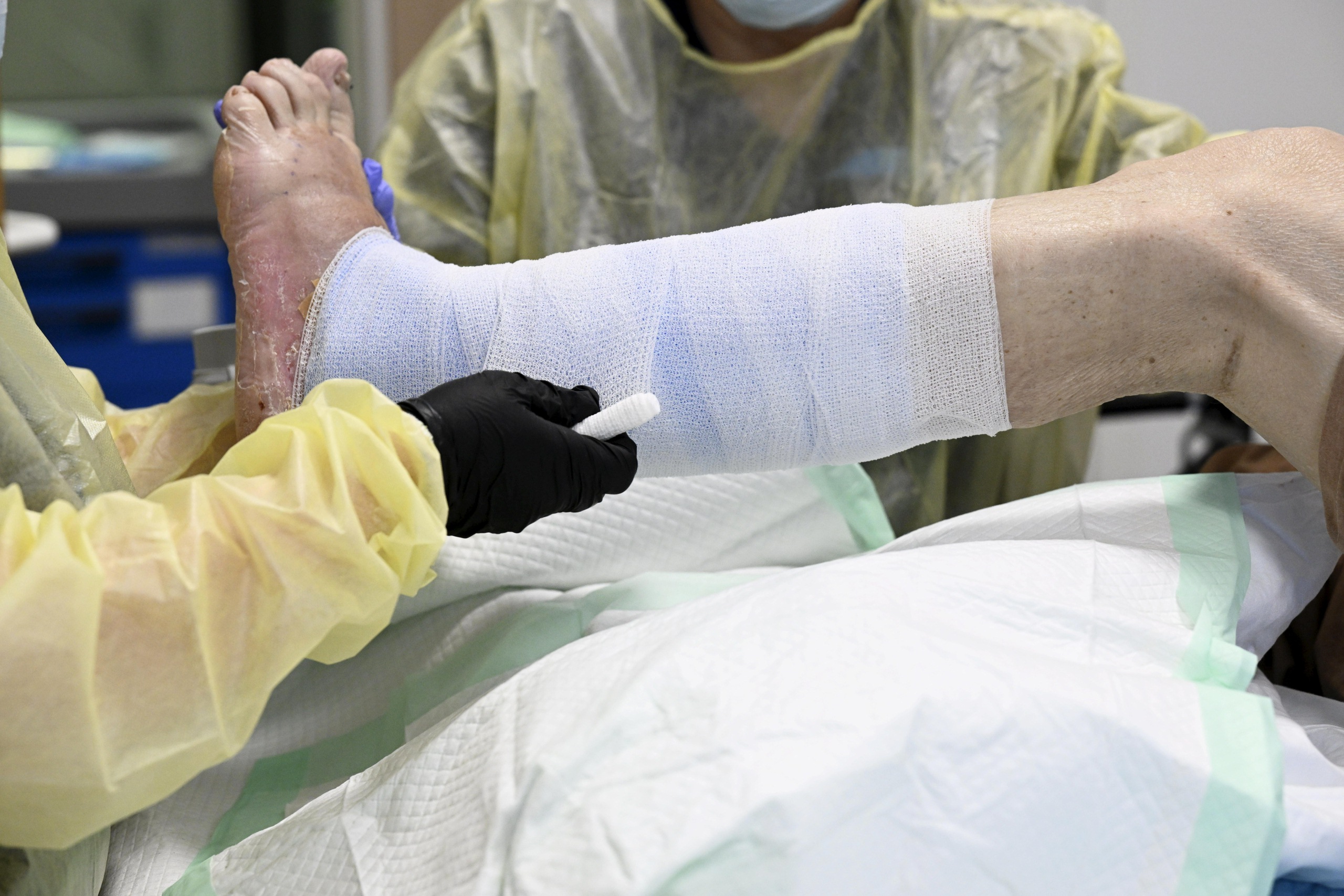 Haavoja voidaan hoitaa sairaaloissa toukilla tai iilimadoilla