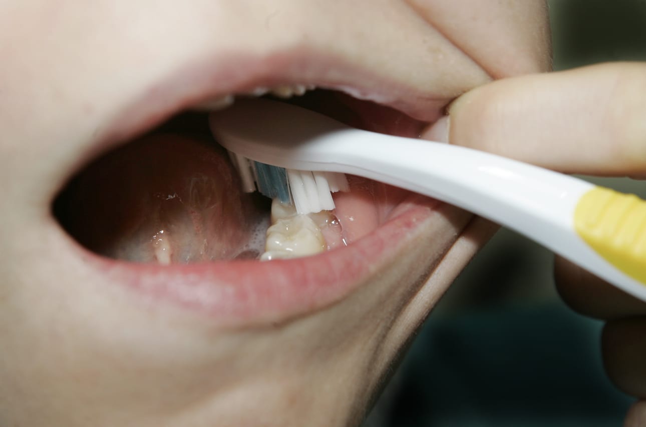 Tilastojen mukaan pojat harjaavat hampaitaan tyttöjä laiskemmin.