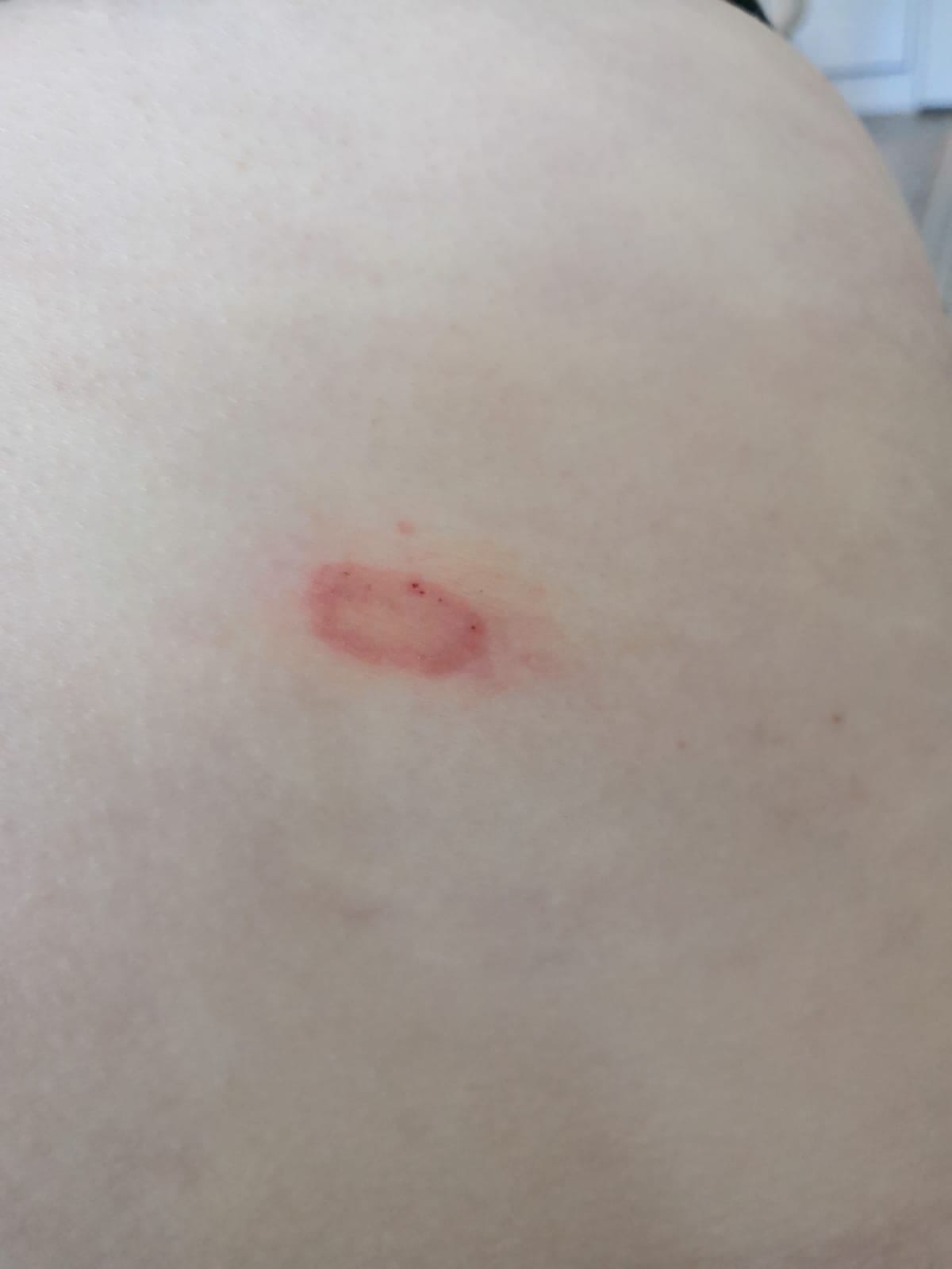 Punkinpureman ympärille muodostui rengasmainen ihottuma, joka vähitellen laajeni ja tummui, kertoo Johanna Poussu.