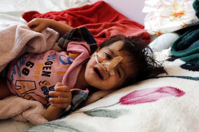 Sodan tulos. Aliravittu lapsi makaa sairaalassa Jemenin pääkaupungissa Sanaassa 18. maaliskuuta. Raporttien mukaan yli kaksi miljoonaa lasta kärsii Jemenissä akuutista aliravitsemuksesta. KUVA: EPA/YAHYA ARHAB