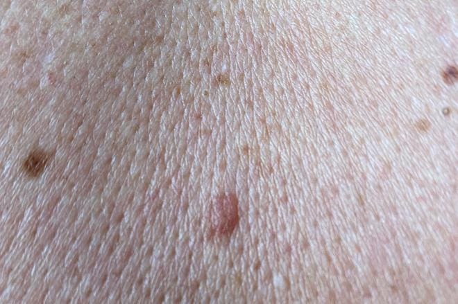Kuvassa näkyvät suurimmat luomet ovat erityyppisiä, mutta molemmat hyvänlaatuisia.