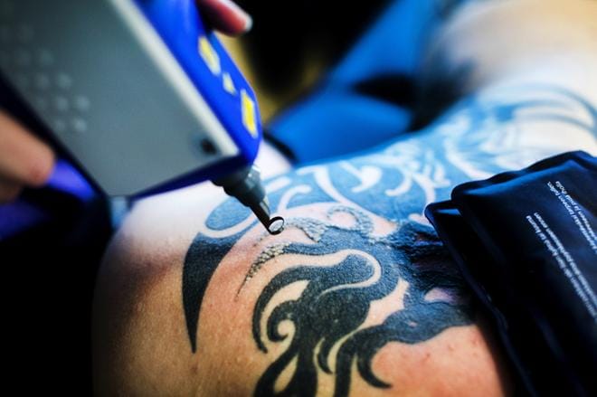 Tässä tatuoinnissa on vain mustaa, joka on kaikkein helpoin väri poistaa. Vaikeimpia värejä ovat vihreä ja sininen. KUVA: KRISTA LUOMA