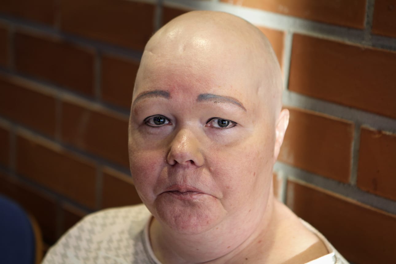 Johannan 50v. sairastaa alopecia universalista.