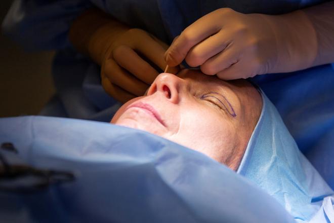 "Roska" silmässä olikin oma silmäluomi – Seurasimme yläluomileikkausta, joiden syynä ei läheskään aina ole ulkonäön korjaaminen