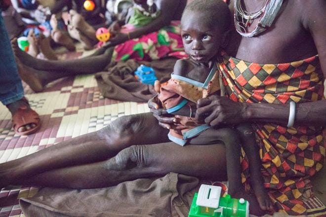 2-vuotias Lobato saa hoitoa vakavaan aliravitsemukseensa Unicefin tukemalla terveysklinikalla Kapoetan kaupungin pohjoispuolella alueella, joka on nälänhädän partaalla.