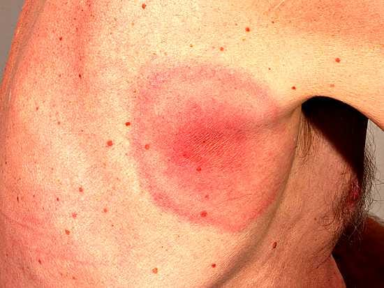 Tämä mies sai Borrelia-infektion kainalon taakse. Laajeneva punarengas on tyypillinen oire, mutta taudinkuva voi olla hämäävän moni-ilmeinen.