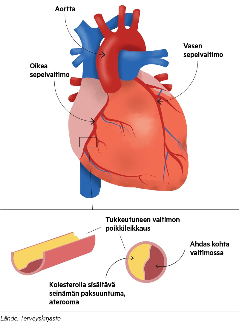 kohtalokas-potilasvahinko-koskettaa-omaisten-lis-ksi-hoitohenkil-kuntaa