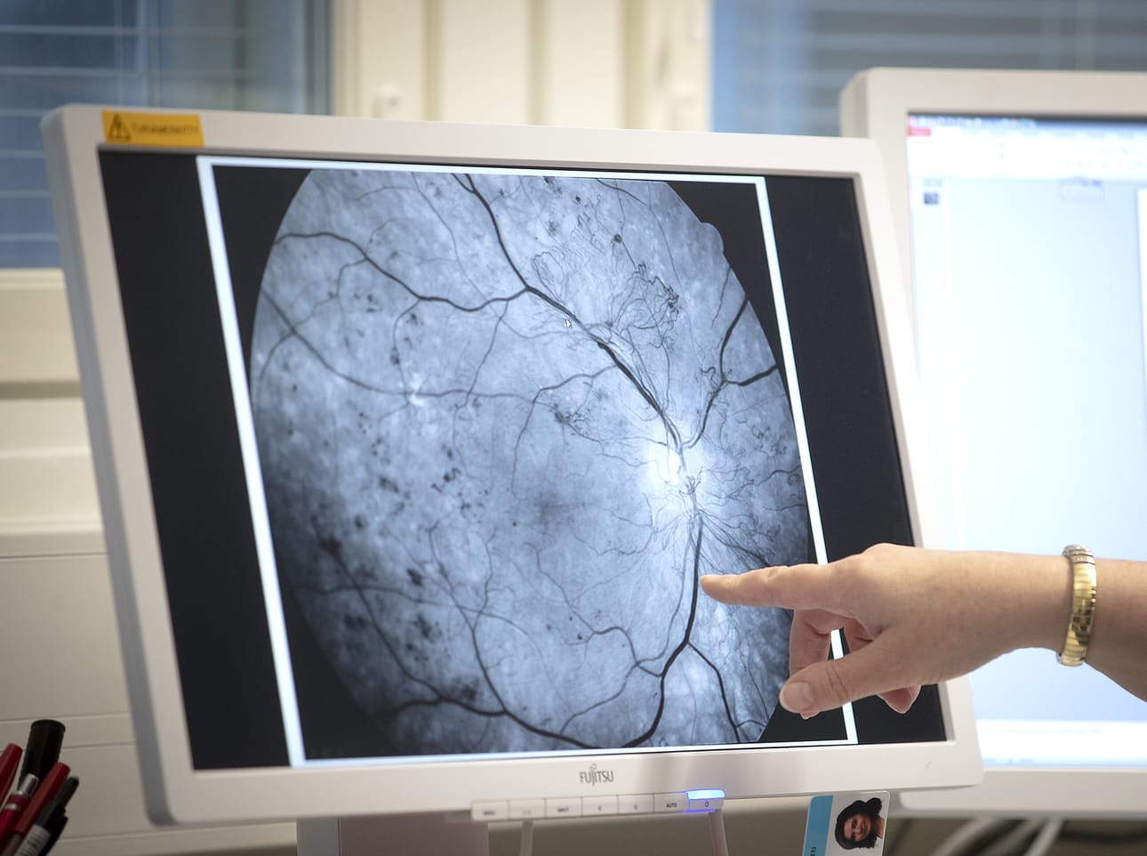 Silmätoiminnan kokonaisvolyymin on arvioitu olevan yksistään Raahen seutukunnan osalta noin miljoona euroa vuodessa. Sairaanhoitopiirin tuleminen mukaan toimintaan toisi lisää volyymia muiltakin alueilta.