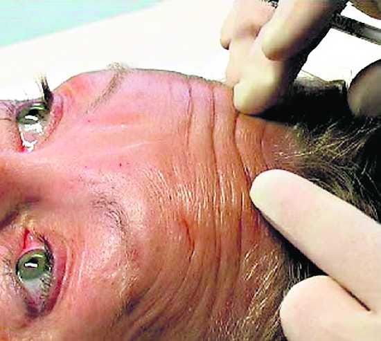 Ilmerypyt pienemmiksi. Otsajuonteet siliävät botox-ruiskeella, kun pienet lihakset lamaantuvat. Kuva Botuliiniklinikalta.