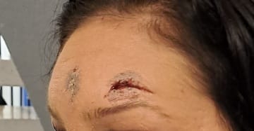 Poliisipartio kuvasi kaapatun naisen vammat Haminassa päivä kaappauksen jälkeen. Tuolloin nainen vakuutti, että kaikki on kunnossa.