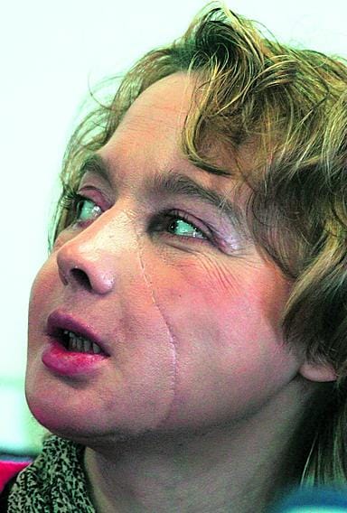 Isabelle Dinoire kertoi kasvoleikkauksestaan tiedotustilaisuudessa.