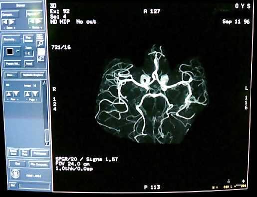 Aivovaltimot näkyvät magneettikuvauslaitteella kolmiulotteisina ja tarkkarajaisina.