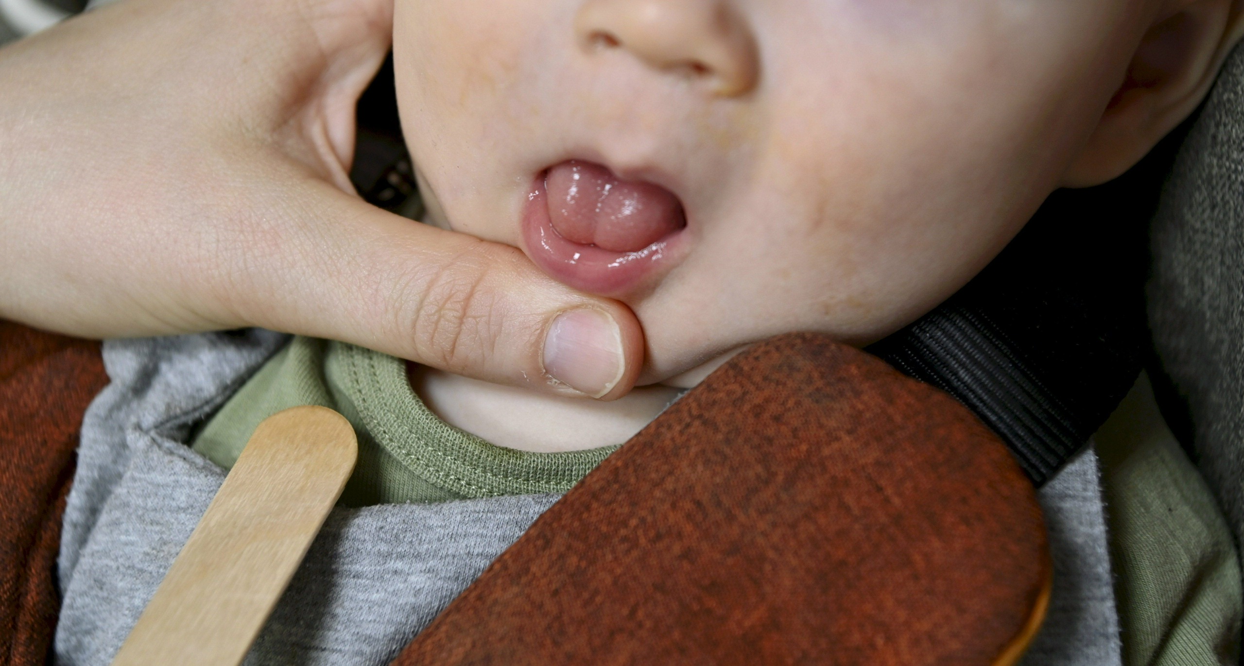 Vauvojen kielijänteitä katkaistaan satoja enemmän kuin pari vuotta sitten – "Lasten suussa ei ole tapahtunut mitään sellaista anatomista muutosta"