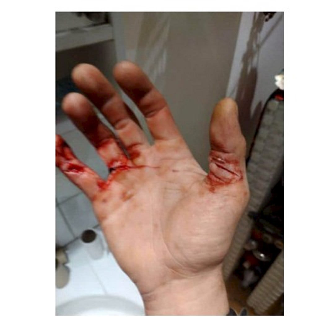 Poliisin mukaan uhreja uhattiin väkivallalla ja pahoinpideltiin. Kuva yhden uhrin vammasta.