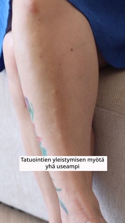 Sattuuko tatuoinnin poisto?