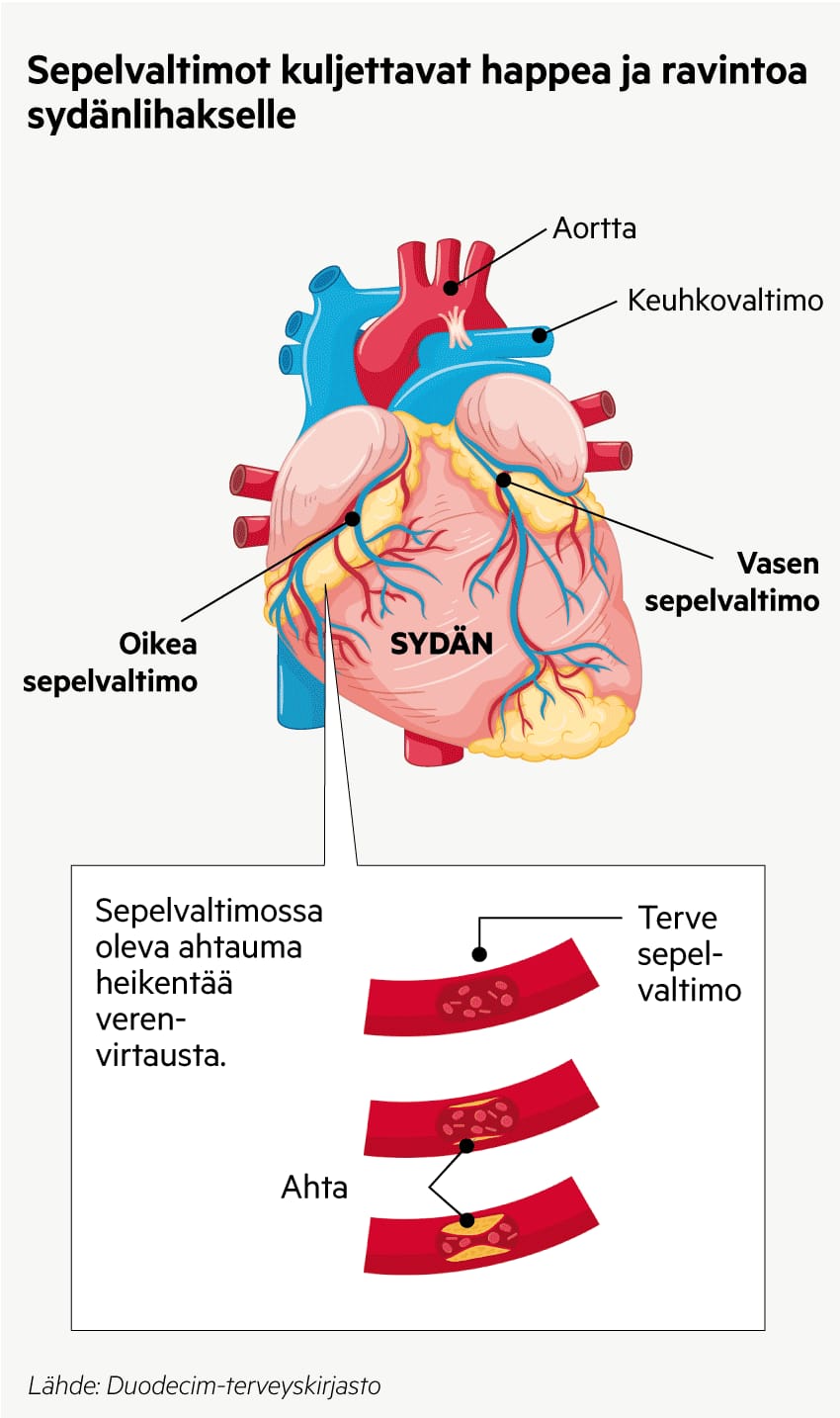 Sepelvaltimotauti Vie Hautaan Lapissa Useammin Kuin Muualla Yksi sepelvaltimotauti-vie-hautaan-lapissa-useammin-kuin-muualla-yksi