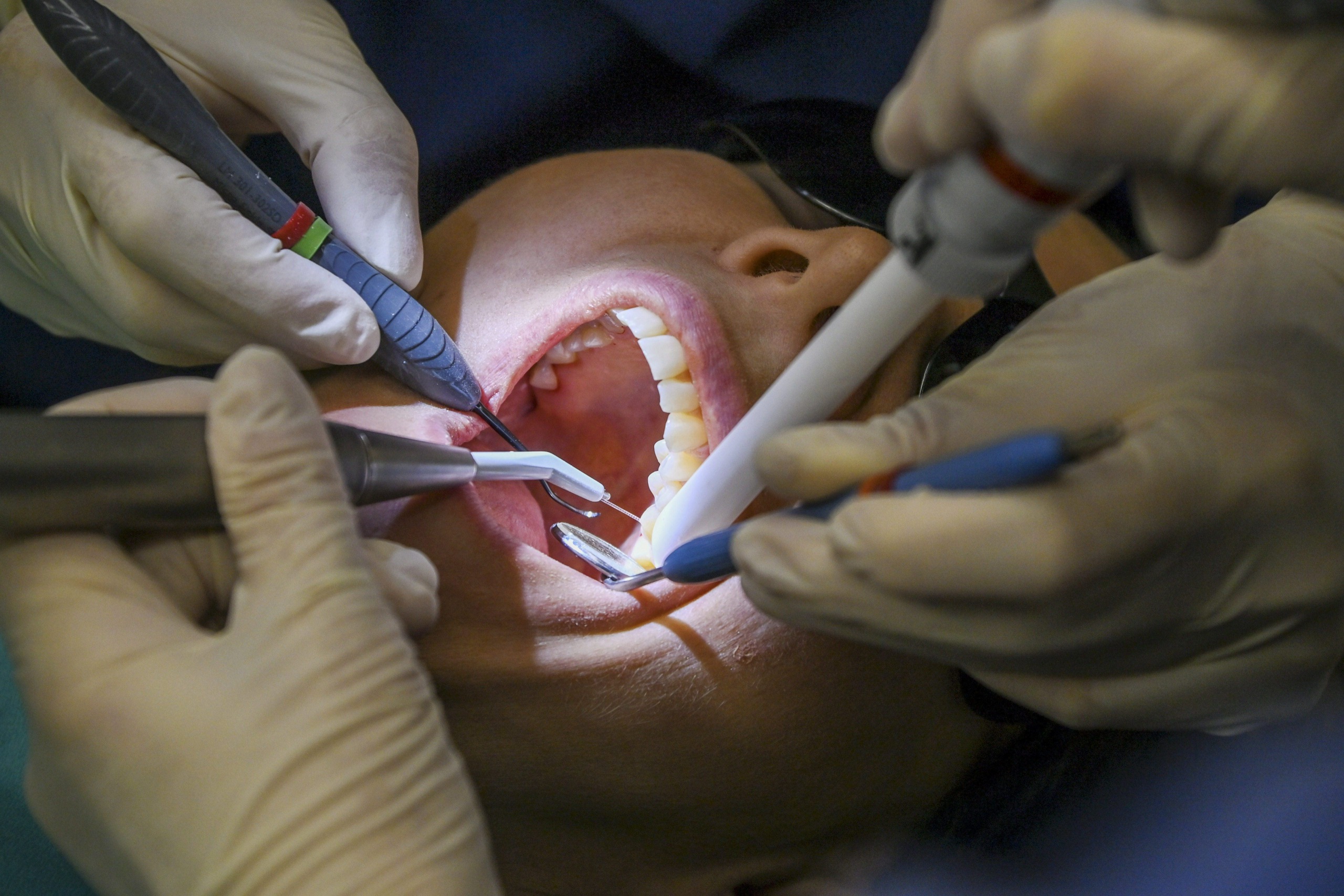 Ulkomailla tehtyjä esteettisiä hoitoja ei tilastoida, mutta hammaslääkäri näkee pieleen menneitä hoitoja vastaanotollaan – "Nämä tapaukset ovat lisääntyneet"